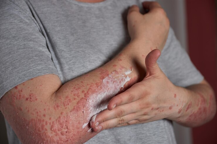 Common Bacterial Skin Infections